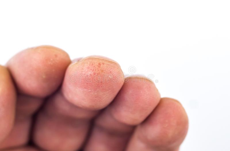Como Prevenir o Descascamento das Pontas dos Dedos?