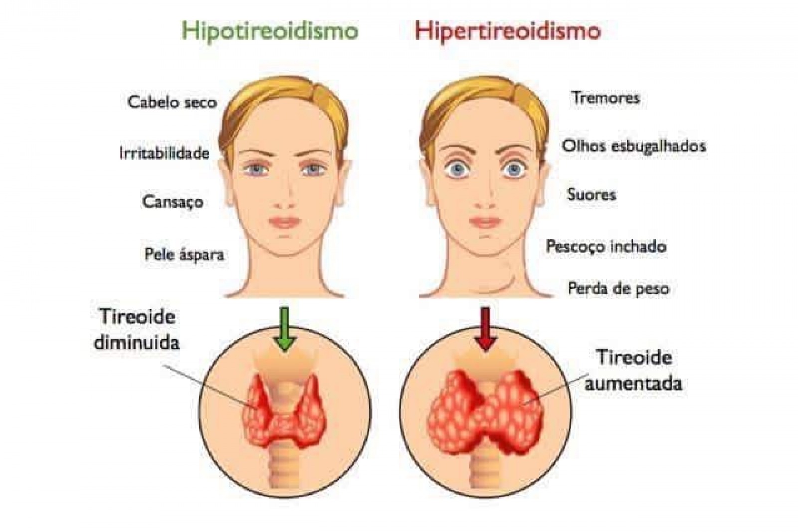 Гипо и гипертиреоз. Заболевания щитовидки. Патология щитовидной железы симптомы. Гиперфункция щитовидной железы.